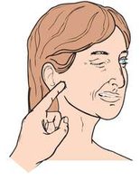 Illustration of Chvostek's sign (facial twitch)