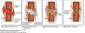 Remodeling of bone after fracture repair