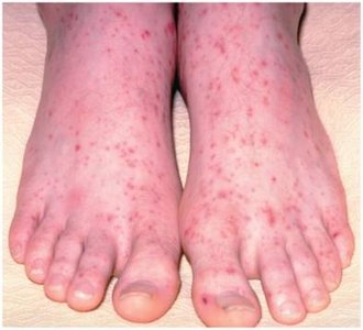 Petechiae in bleeding disorder