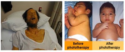 Jaundice in adults and infants