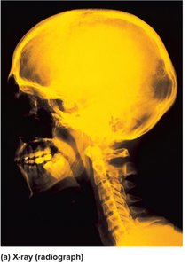 X-ray radiograph of skull