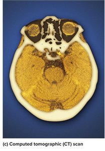 CT scan of the head