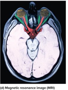 MRI scan of the head