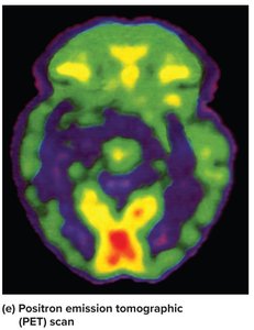 PET scan of the head