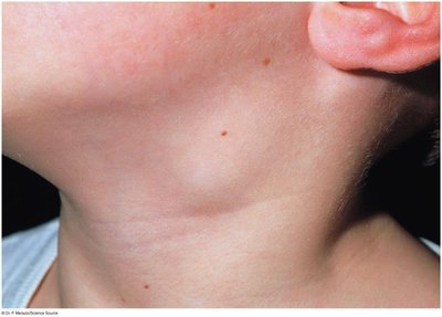 Enlarged lymph node in the neck