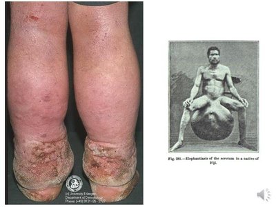 Lymphedema and its effects