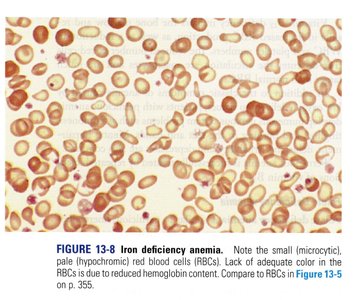 Microscopic image of iron deficiency anemia