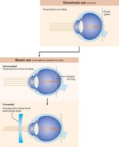 Myopia (nearsightedness) and correction