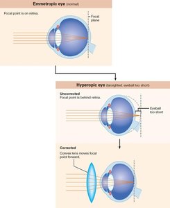 Hyperopia (farsightedness) and correction