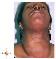 Goiter (enlarged thyroid)