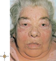 Myxedema (facial edema)