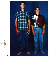 Gigantism and normal stature comparison