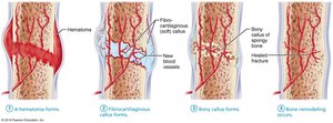 Stages of bone healing