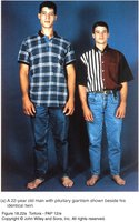 Gigantism: pituitary hypersecretion