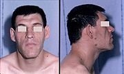 Acromegaly: pituitary hypersecretion