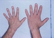 Acromegaly: pituitary hypersecretion