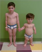 Pituitary dwarfism: hyposecretion