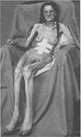 Simmond's disease: hyposecretion