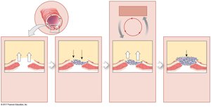 Positive feedback: blood clotting