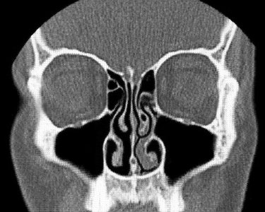Nasal conchae and meatuses