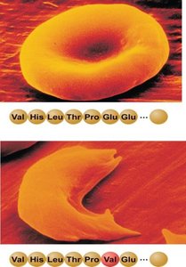 Normal and sickle-shaped erythrocytes