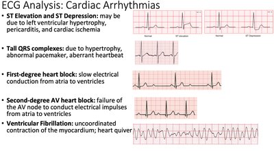 ECG analysis: cardiac arrhythmias