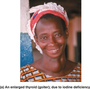 An enlarged thyroid (goiter) due to iodine deficiency