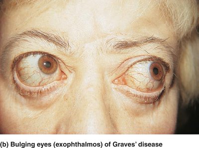 Bulging eyes (exophthalmos) of Graves' disease