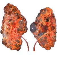 Polycystic kidney disease