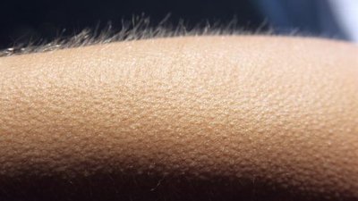 Goosebumps on skin