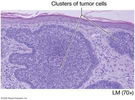 Clusters of tumor cells in carcinoma