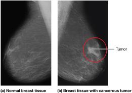 Mammogram showing normal and cancerous breast tissue