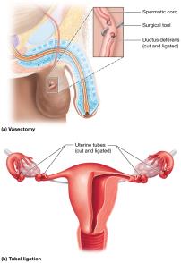 Permanent methods of birth control: vasectomy and tubal ligation