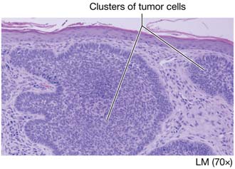 Clusters of tumor cells in epithelial tissue