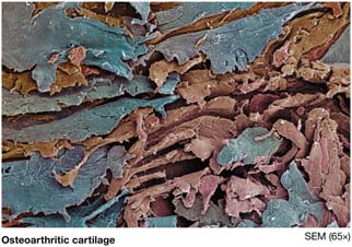 Osteoarthritic cartilage under SEM