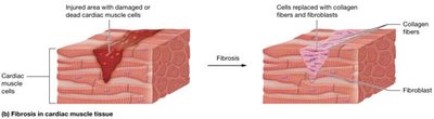 Fibrosis in cardiac muscle tissue