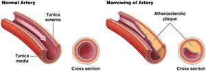 Comparison of normal artery and narrowed artery with atherosclerotic plaque.