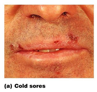 Cold sores on lips