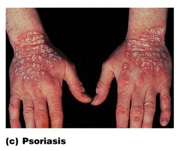 Psoriasis on hands