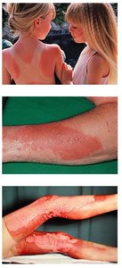 Examples of burn severity