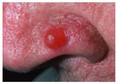 Basal cell carcinoma