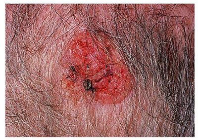 Squamous cell carcinoma