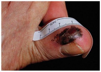 Malignant melanoma