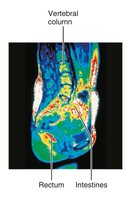 Sagittal MRI section