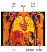 Frontal MRI section