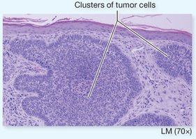 Clusters of tumor cells in carcinoma