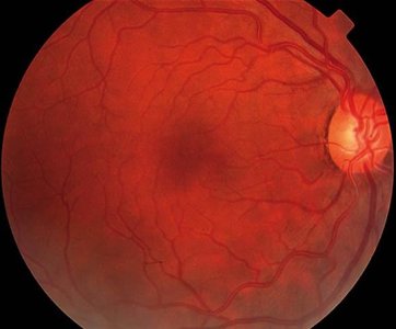 Photograph of the retina
