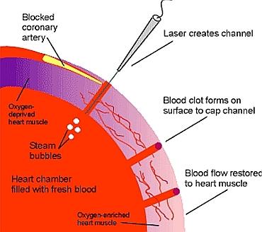 Diagram of TMR procedure showing laser-created channels in heart muscle