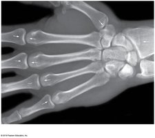 Epiphyseal lines in adult bone