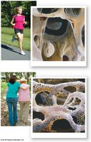 Effects of osteoporosis on spongy bone